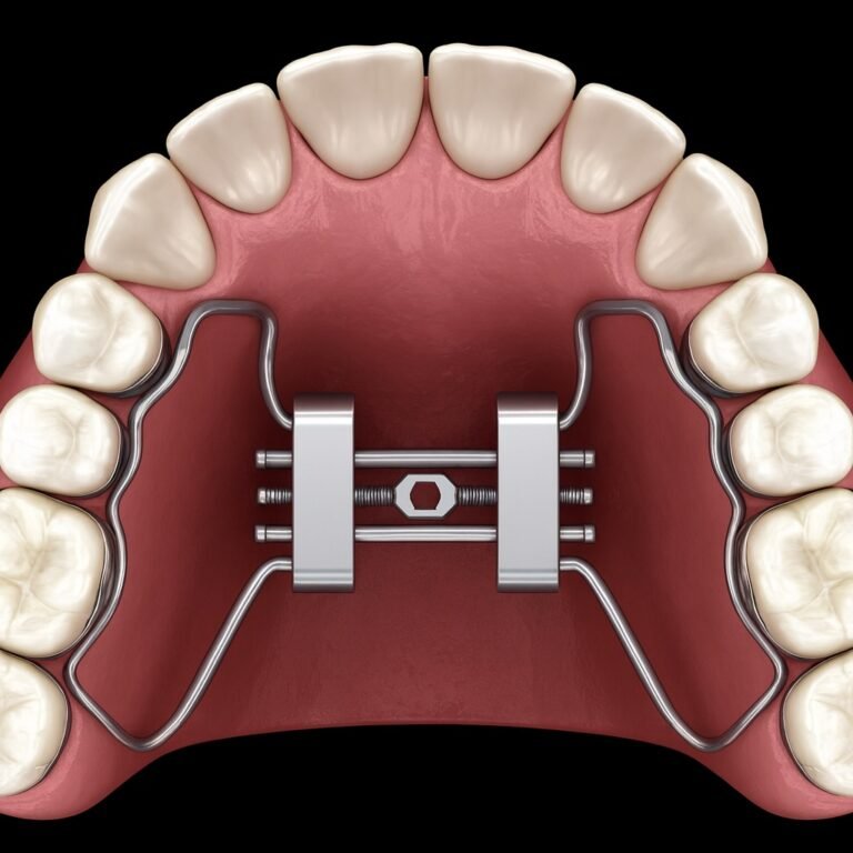 disjunctor dentar fix pe arcada superioară